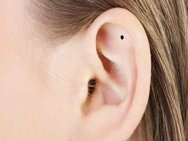 nốt ruồi trong vành tai